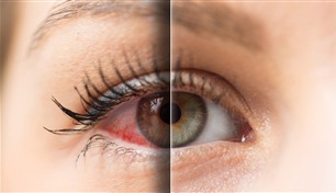 جفاف العين يغير تركيبة الميكربيوم