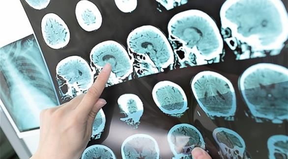 صورة أشعة لدماغ أحد المرضى المصابين بسرطان المخ(أرشيف)