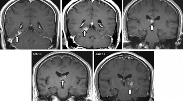 لأول مرة: نجاح العلماء في إزالة دودة شريطية من دماغ رجل 201411221057197