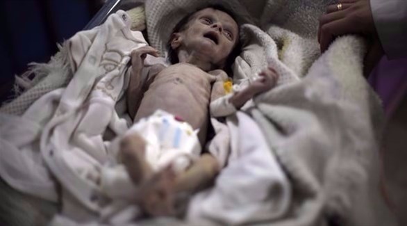 صورة الطفلة السورية سحر قبل وفاتها جراء الجفاف الحاد (إ ف ب)