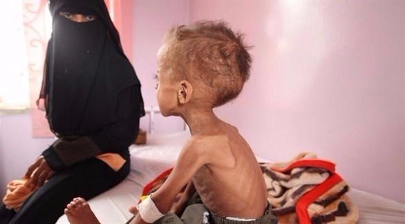 طفل من ضحايا المجاعة في اليمن (أرشيف)