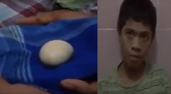 صبي يضع البيض يحير الأطباء في إندونيسيا (ديلي ميل)