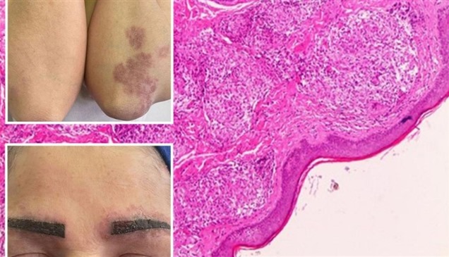 صيحة تجميل شائعة تُصيب امرأة بمرض نادر ينتشر في جسدها بالكامل