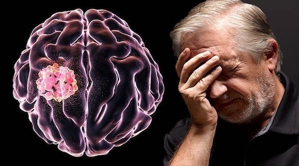 5 أعراض مبكرة لأورام الدماغ السرطانية