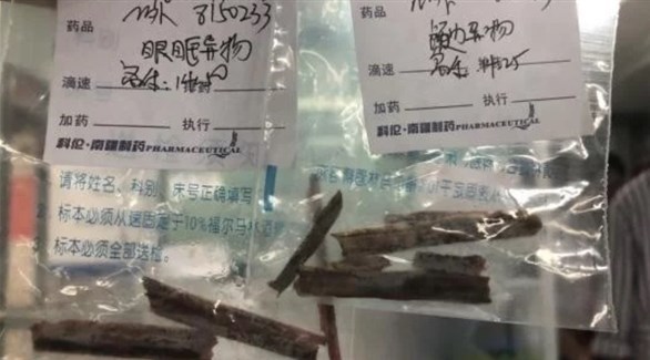 إزالة شطايا من الخشب من دماغ مريض في الصين (أوديتي سنترال)