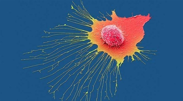 رسم تعبيري لخلايا سرطان الثدي