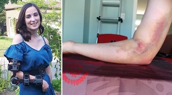 أصيبت غابرييلا إيكمان بالشلل في ذراعها الأيمن (أوديتي سنترال)