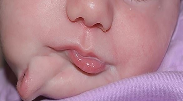 ولدت الطفلة بفم إضافي بسبب حالة نادرة (ديلي ميل)