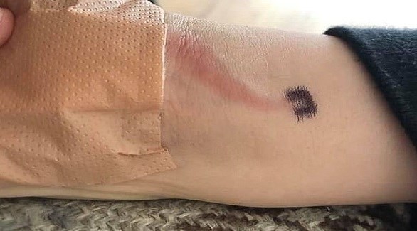 أصيب ذراع الطفل بعدوى تسببت بتعفن الدم لديه بعد تعرضه لجرح في ذراعه (ديلي ميل)