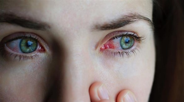 نصائح لعلاج التهاب ملتحمة العين 202112211543320WU.jp
