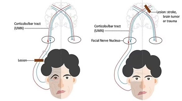 شلل الوجه النصفي من الآثار الجانبية لفيروس كورونا (ديلي ميل)