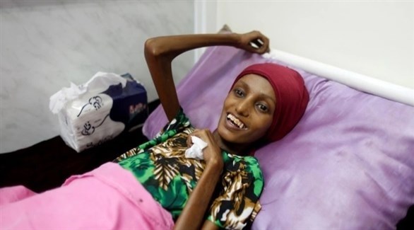 فتاة تعاني من سوء التغذية الحاد في مستشفى الثورة بمدينة الحديدة  (أرشيف)