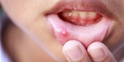 فطريات الفم.. أسبابها وأعراضها
