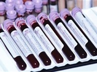 فحص جديد للدم يكشف 50 نوعاً من السرطان
