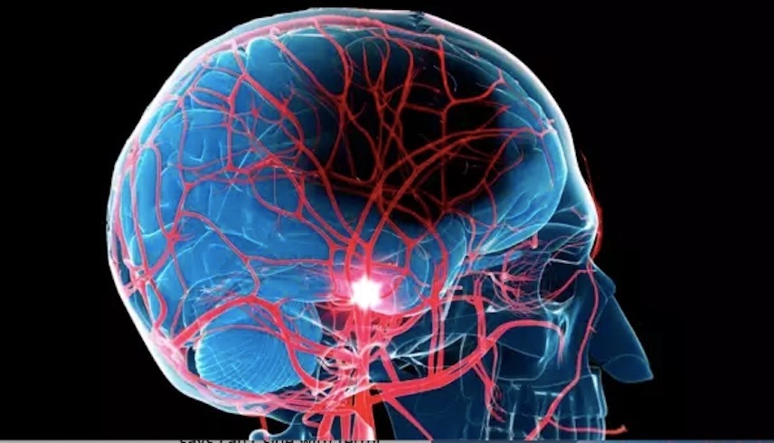  تحدث السكتة الدماغية بسبب انقطاع تدفق الدم إلى الدماغ (ارشيف)