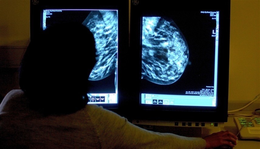 فحص صورة الإشعاعات للكشف عن سرطان الثدي (أرشيف)