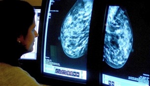 علماء يطورون خوارزمية بالذكاء الاصطناعي للتنبؤ بسرطان الثدي